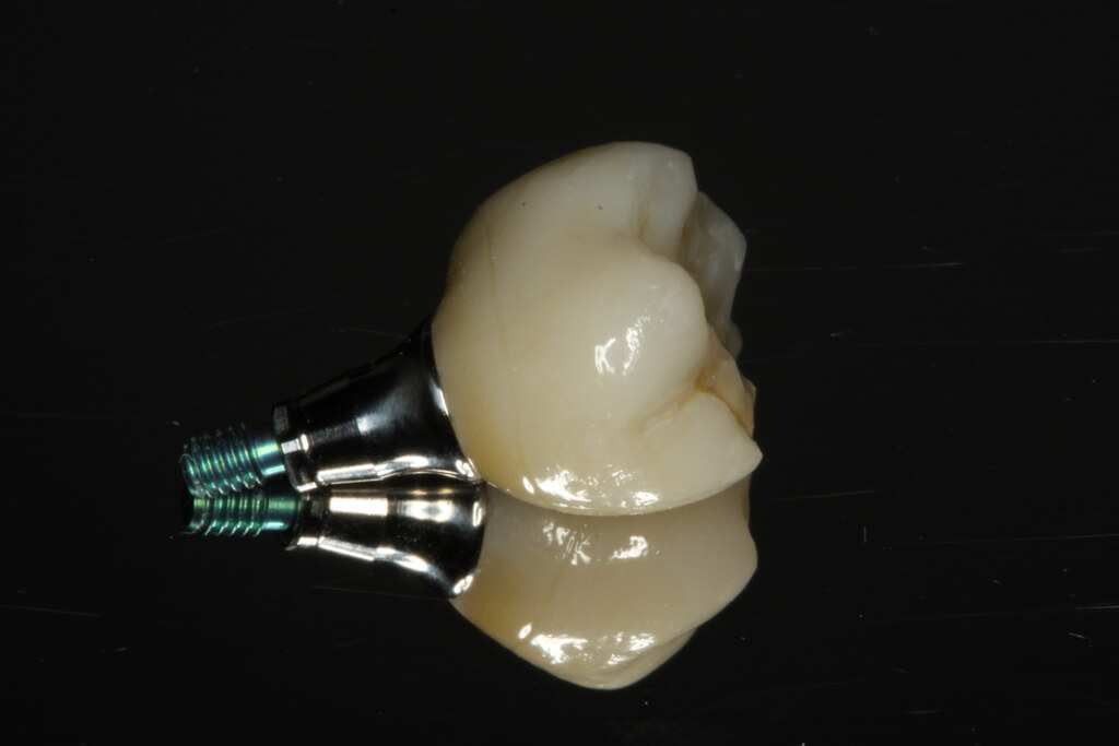 dental implants in lower arch