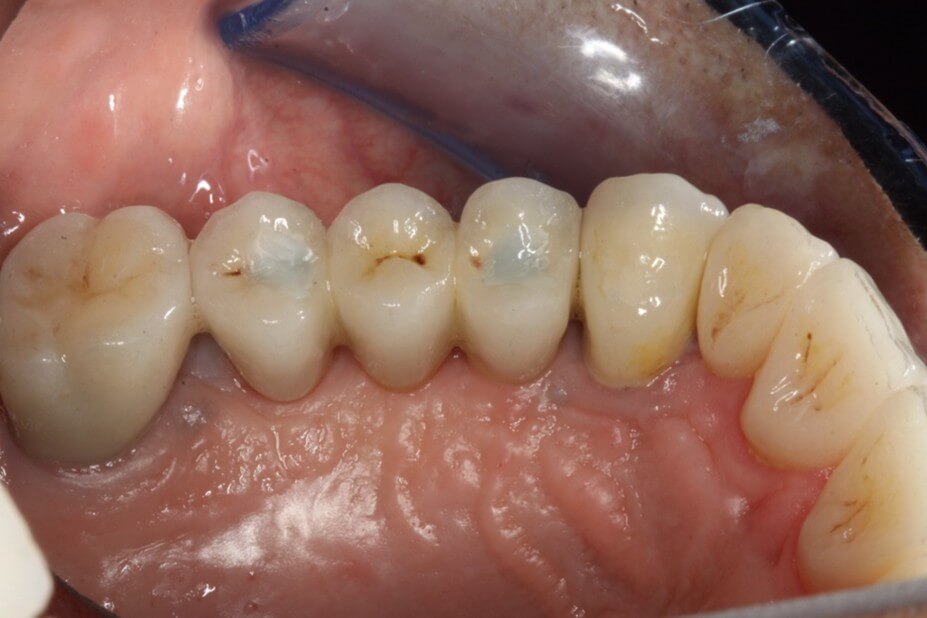 implant bridge 01 a