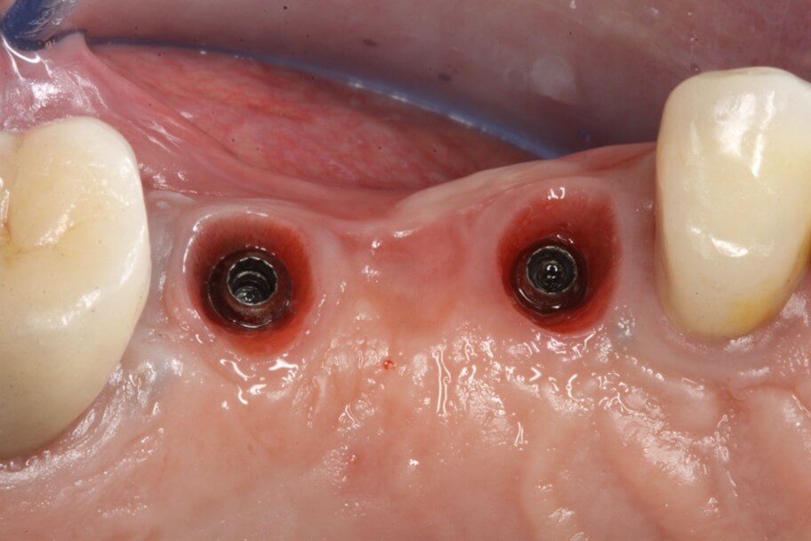 implant bridge 01 b