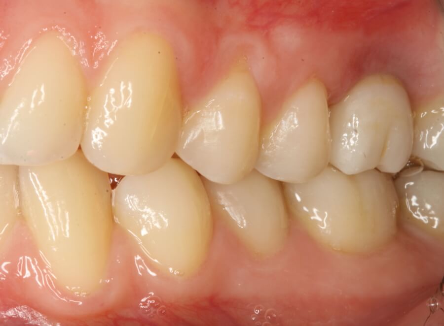 implants b