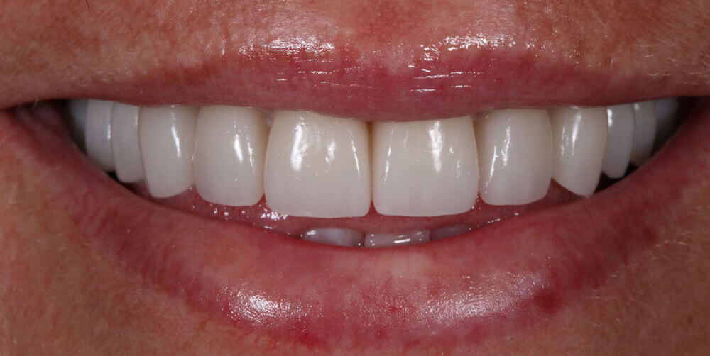 SMILE MAKEOVER - Μετά