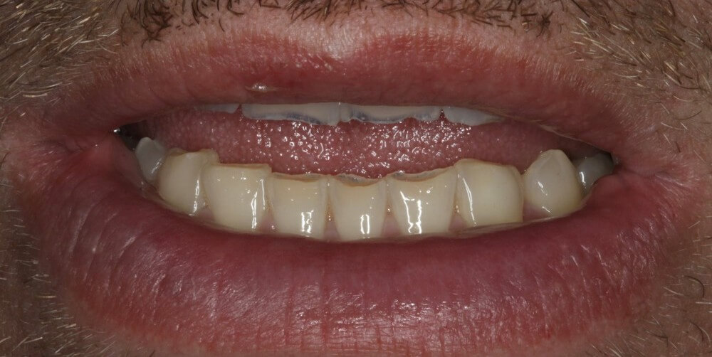 SMILE MAKEOVER - Πριν