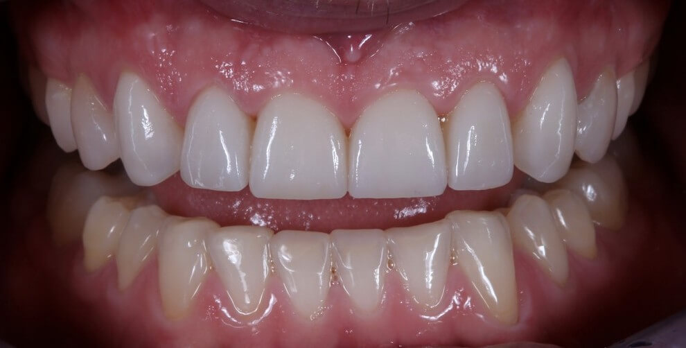 SMILE MAKEOVER - Μετά
