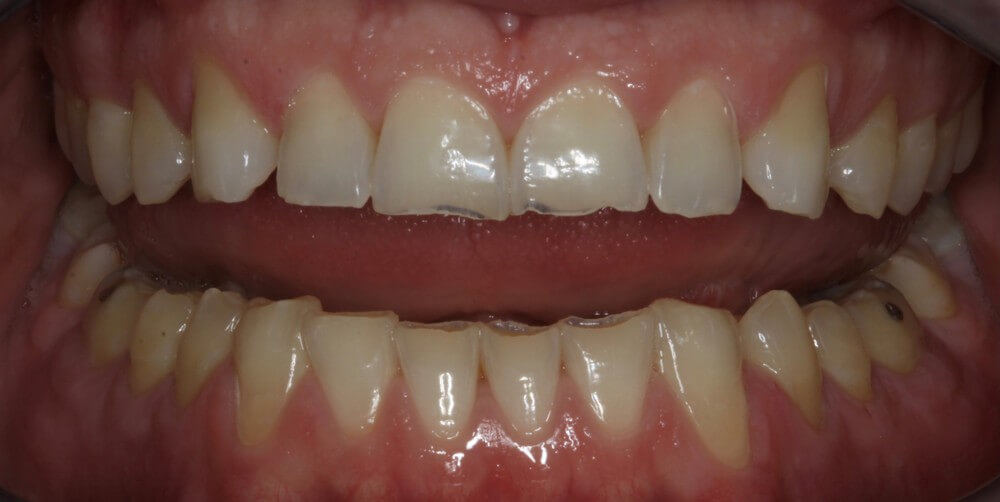 SMILE MAKEOVER - Πριν