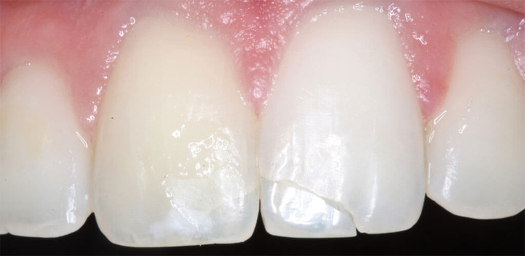 Aesthetic Composite Resin Restorations iDentical Dental Clinic