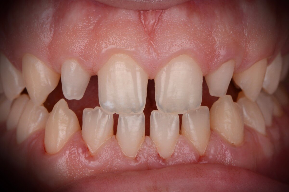 composite veneers 01