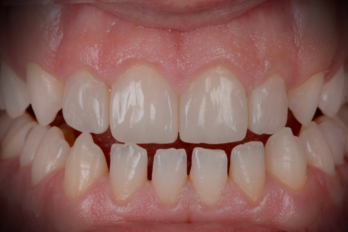 composite veneers 02